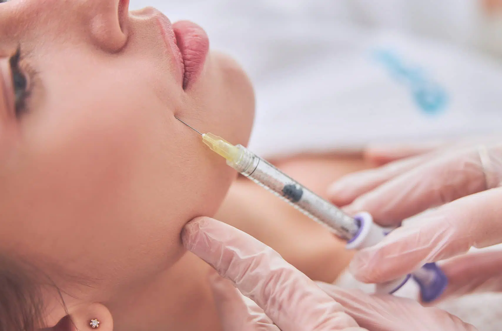 Acide hyaluronique : les rides des sillons nasogéniens | Paris | Dr Pecorelli