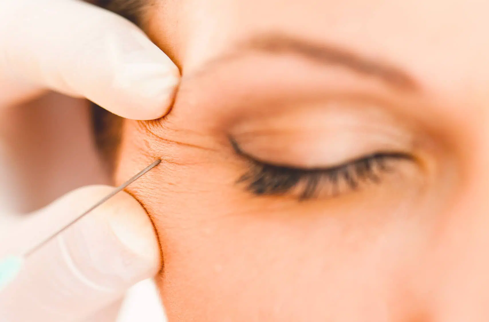 Injection de Botox : zone de la patte d'oie | Paris 16 | Dr Pecorelli