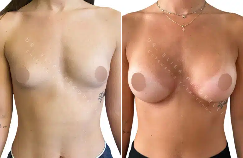 Dr Pecorelli | Augmentation mammaire | Paris 16