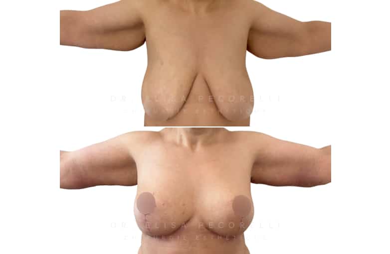 Dr Pecorelli | Réduction mammaire et lifting des bras | Paris 16