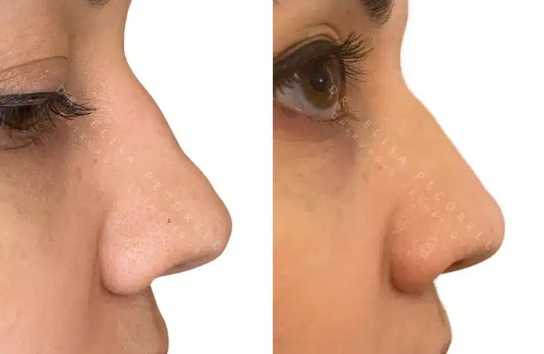 Acide hyaluronique avant/Apres | Dr Elisa Pecorelli | Paris 16