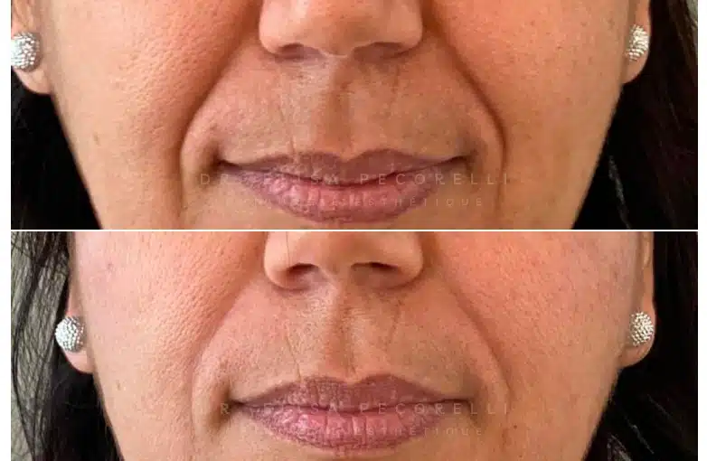 Acide hyaluronique avant/Apres | Dr Elisa Pecorelli | Paris 16