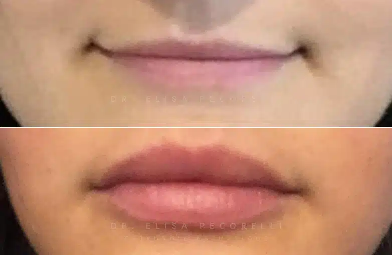 Acide hyaluronique avant/Apres | Dr Elisa Pecorelli | Paris 16