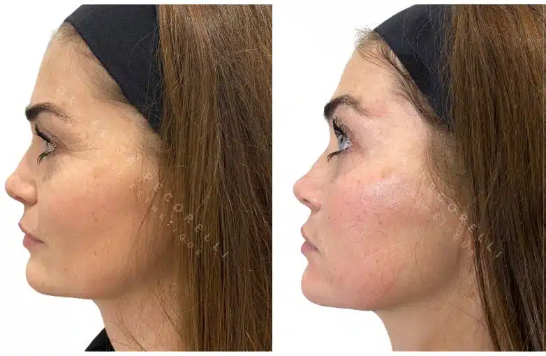 Acide hyaluronique avant/Apres | Dr Elisa Pecorelli | Paris 16