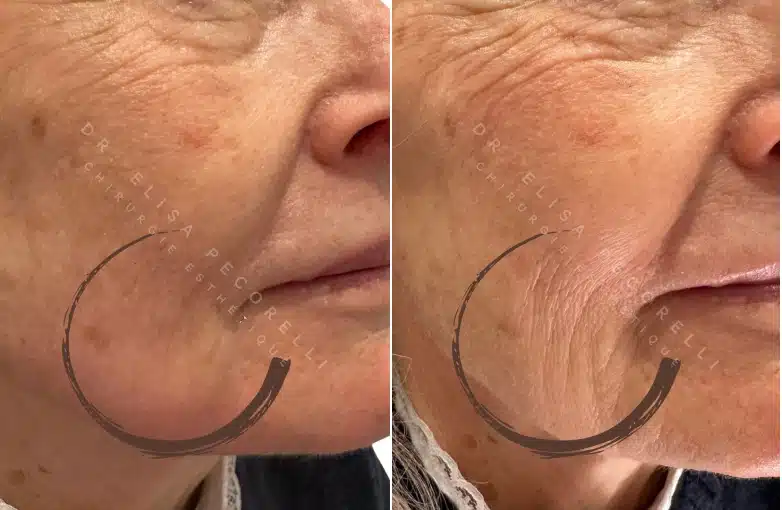 Acide hyaluronique avant/Apres | Dr Elisa Pecorelli | Paris 16
