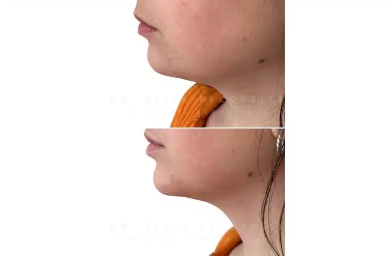 Acide hyaluronique avant/Apres | Dr Elisa Pecorelli | Paris 16