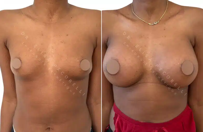 Dr Pecorelli | Augmentation mammaire | Paris 16
