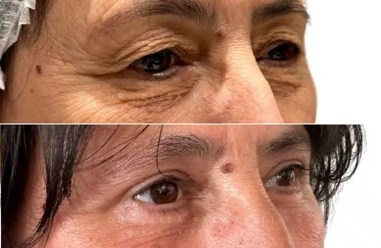 Blépharoplastie | Dr Pecorelli | Paris