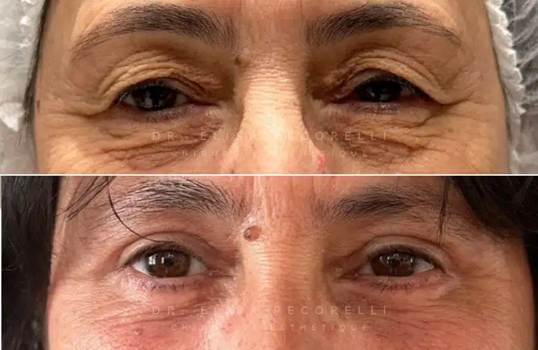 Blépharoplastie | Dr Pecorelli | Paris