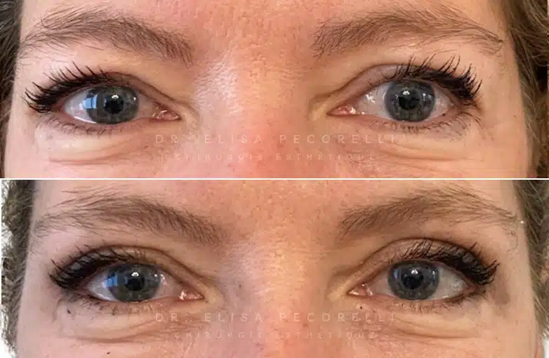 Blépharoplastie | Dr Pecorelli | Paris