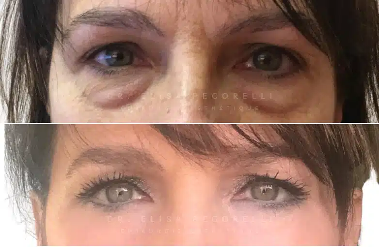 Blépharoplastie | Dr Pecorelli | Paris