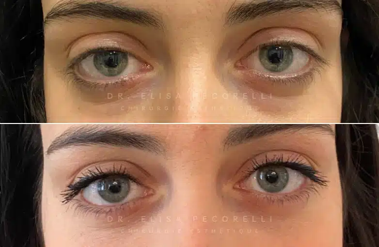 Blépharoplastie inferieur | Dr Pecorelli | Paris