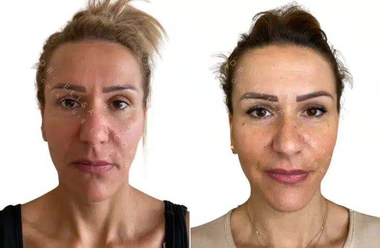 Lifting du visage | Dr Pecorelli | Paris