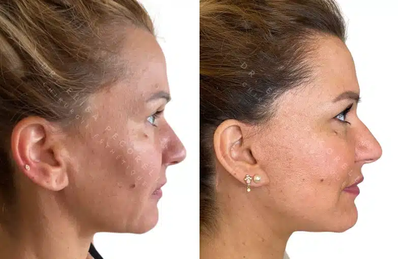 Lifting du visage | Dr Pecorelli | Paris