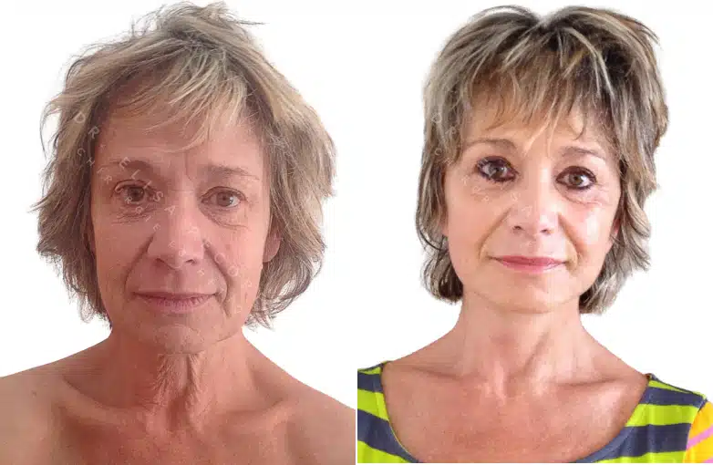 Lifting du visage | Dr Pecorelli | Paris