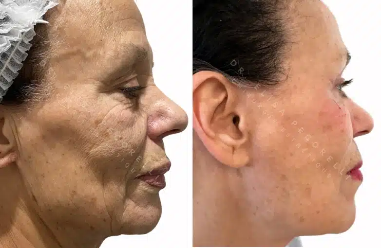 Lifting du visage | Dr Pecorelli | Paris