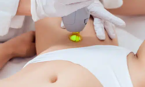 L’importance de faire plusieurs séances d’epilation laser | Dr Elisa Pecorelli | Paris