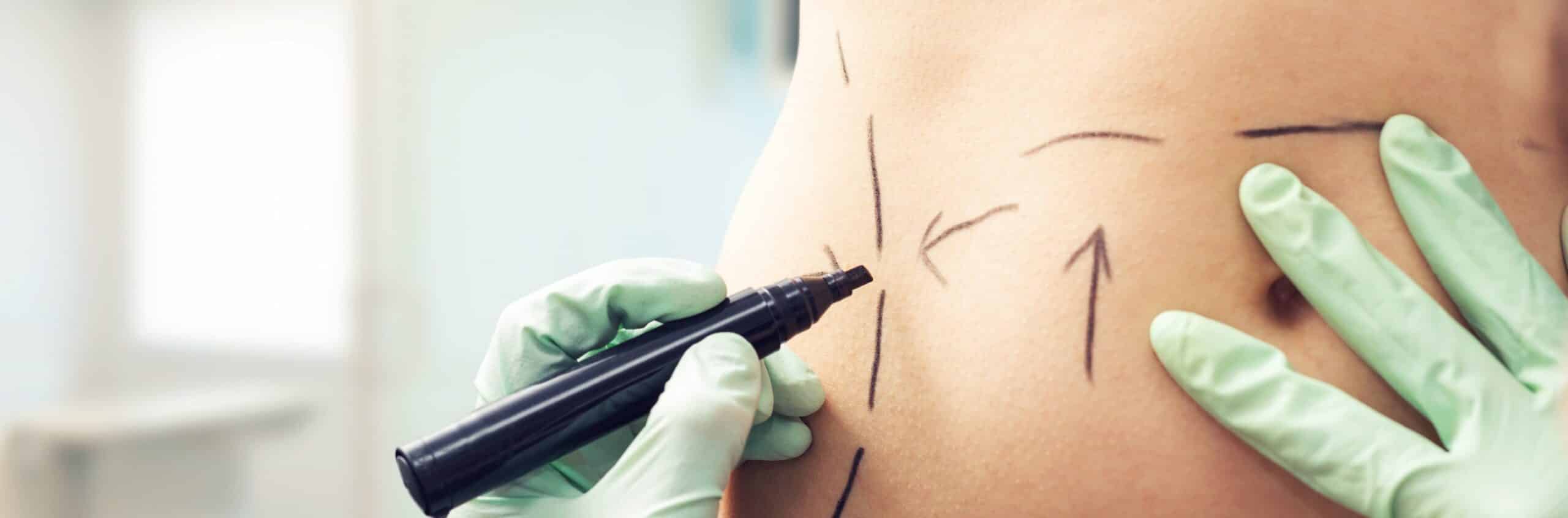 Ou peut-on avoir recours à la liposuccion ? |Dr Elisa Pecorelli | Paris