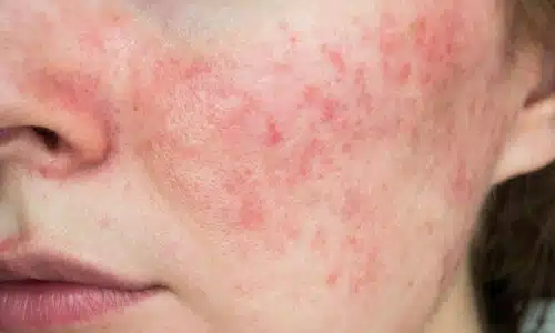 Couperose : quel traitement ? |Dr Elisa Pecorelli | Paris