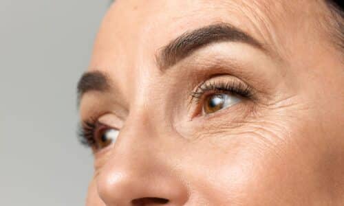 Blépharoplastie