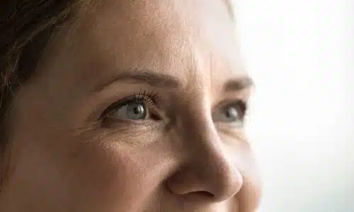 Cicatrices blépharoplastie