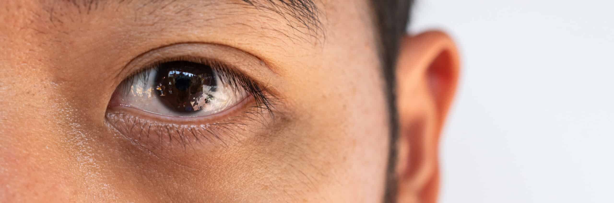 Injections traiter cernes acide hyaluronique autre solution | Dr Elisa Pecorelli | Paris