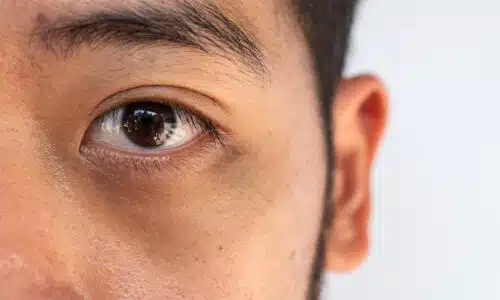 Injections traiter cernes acide hyaluronique autre solution | Dr Elisa Pecorelli | Paris